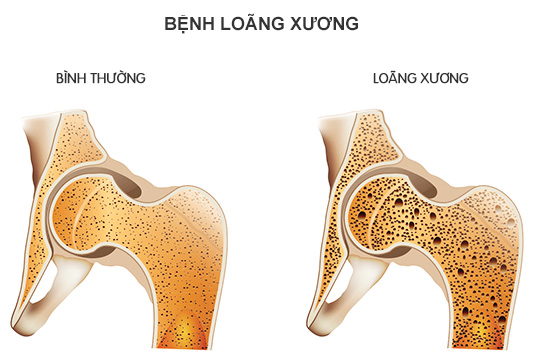 Kết quả hình ảnh cho dáng ngươi thấp bé loãng xương