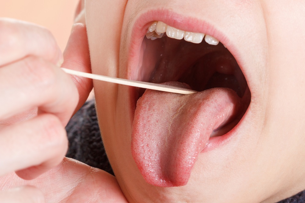 Amidan là một bệnh tai mũi họng phổ biến ở trẻ nhỏ